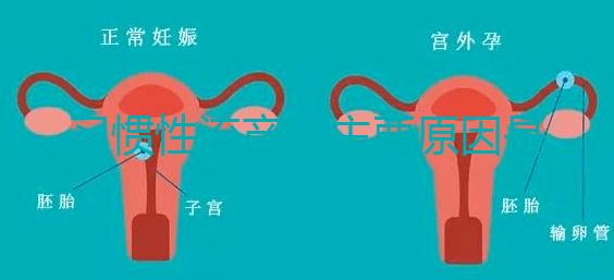習(xí)慣性流產(chǎn)的主要原因是什么？